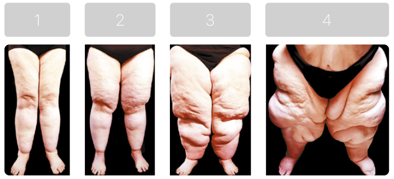 Lipedema 