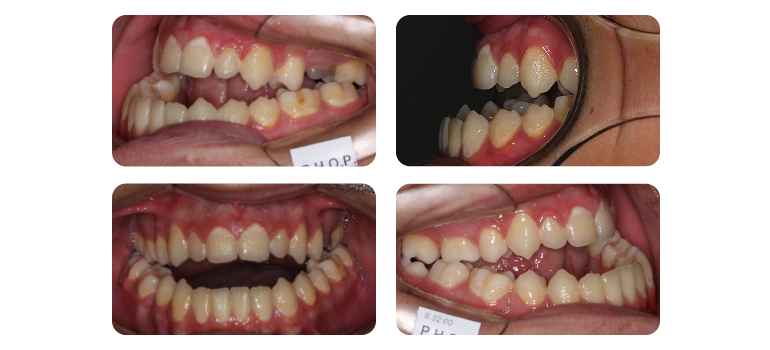TRATAMENTO ORTODÔNTICO PARA CIRURGIA ORTOGNÁTICA