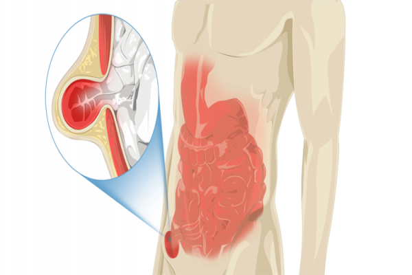 Hérnia abdominal  Hérnia abdominal