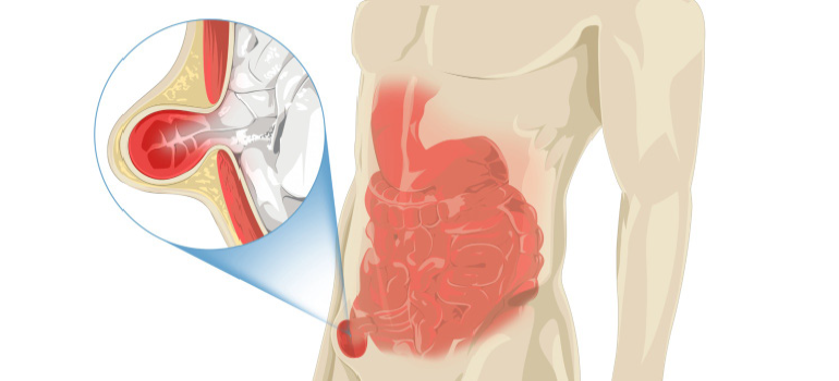 A MINIMAMENTE INVASIVA PARA HÉRNIAS DA PAREDE ABDOMINAL, VANTAGENS E DESVANTAGENS.