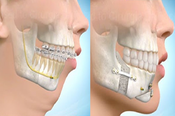 Cirurgia Ortognática: Mais do que a correção estética, um salto na qualidade de vida