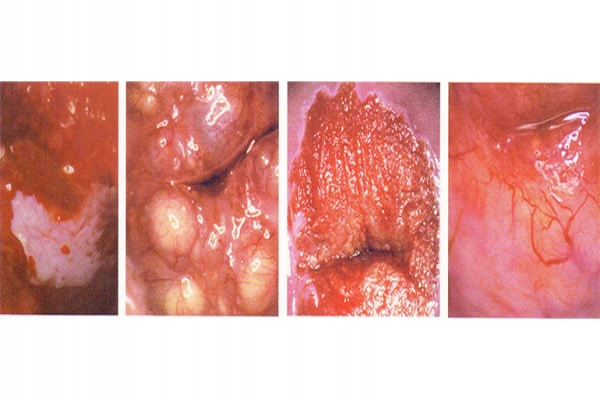 O EXAME DE COLPOSCOPIA O EXAME DE COLPOSCOPIA