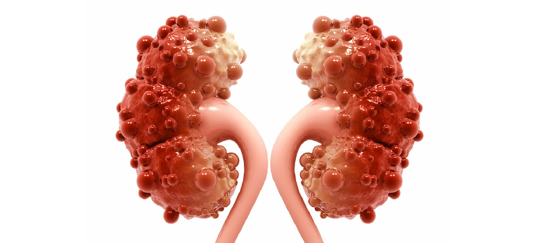 Doença Renal Policística