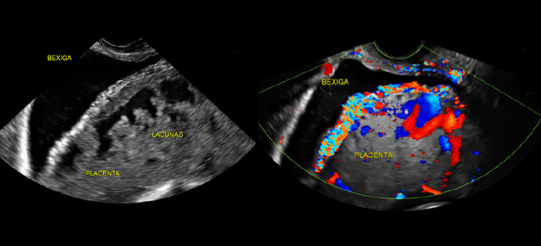 Sinais ultrassonográficos de acretismo placentário  Sinais ultrassonográficos de acretismo placentário