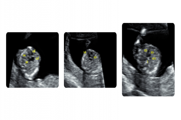 ECOCARDIOGRAFIA FETAL PRECOCE