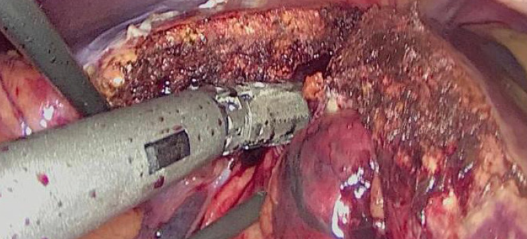 CIRURGIAS DESAFIADORAS DO APARELHO DIGESTIVO