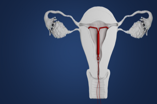 DIU Hormonal Mirena o que é: DIU Hormonal Mirena o que é: