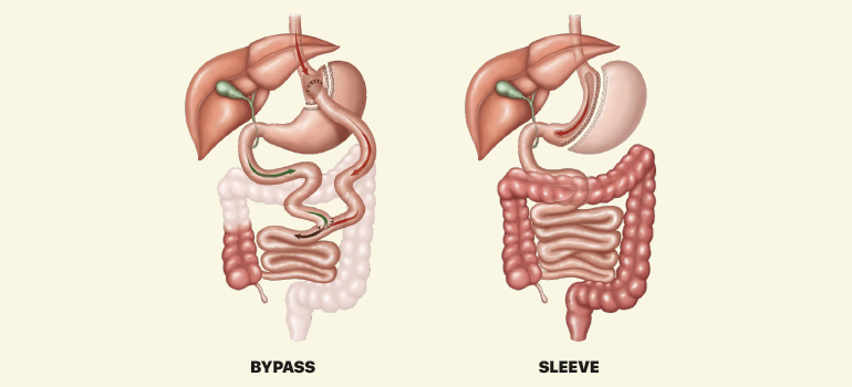 Entenda melhor como a cirurgia bariátrica funciona Entenda melhor como a cirurgia bariátrica funciona