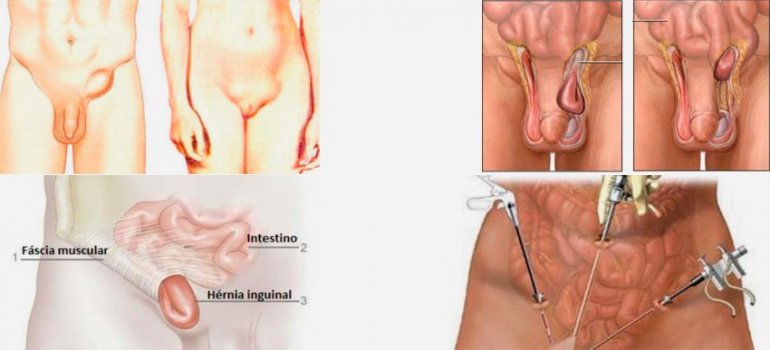 Hérnia Inguinal Videolaparoscópica