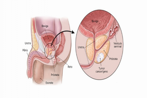 Câncer de próstata