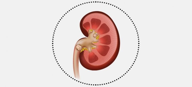 Litíase Urinária (Cálculos Renais) O que é Litíase Urinária?