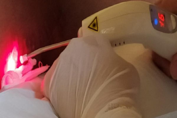 Uso do Laser na Cicatrização de Feridas