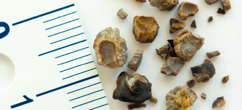 Como evitar as pedras nos rins?