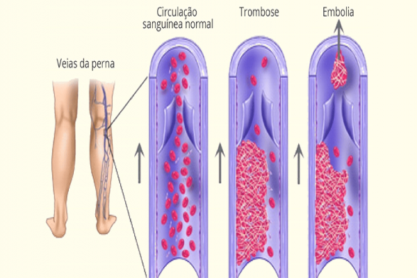 Trombose