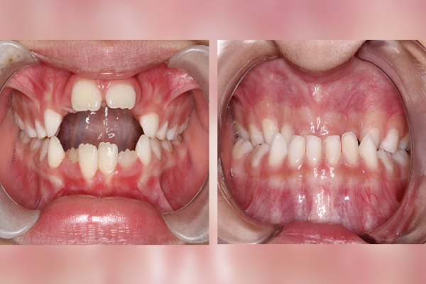 Você sabe o que é Ortopedia Funcional dos Maxilares (OFM)? E você sabia que se for feita no momento correto, pode evitar uma futura Cirurgia Ortognática?
