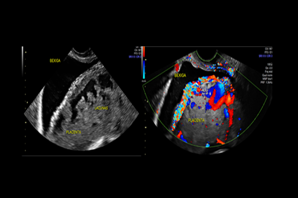 Sinais ultrassonográficos de acretismo placentário