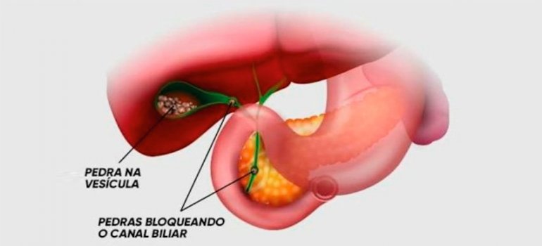 O que é colelitíase ou pedra na vesícula?