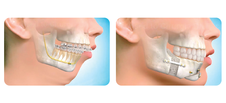 Deformidades Dentofaciais (CIRURGIA ORTOGNÁTICA)