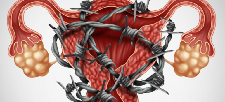 Endometriose e Fertilidade